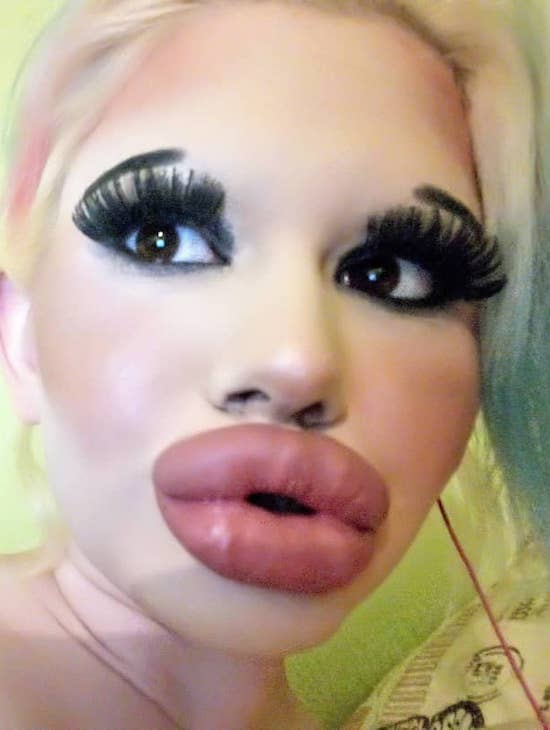 22-Year-Old Instagram Model Wants To Have The ‘Biggest Lips In The World,’ Already Had 15 Procedures To Achieve Her ‘Goal’ 1